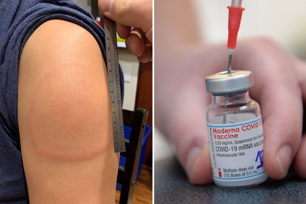 All News US News World News UK News SIDE EFFECTS Moderna vaccine causing ‘Covid arm’ side effects in some patients