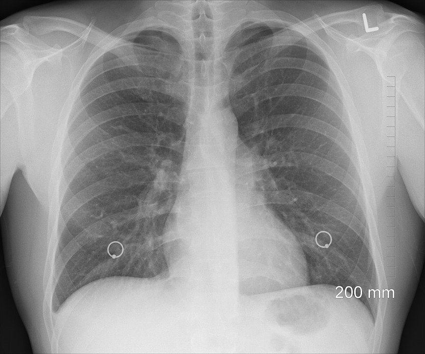 Long-term Mask Use May Contribute to Advanced Stage Lung Cancer, Study Finds