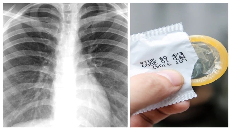 Doctors find condom in woman’s lung