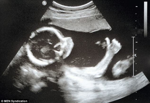 Kentucky Legislature Passes Amendment Saying There’s No Right to Kill Babies in Abortions