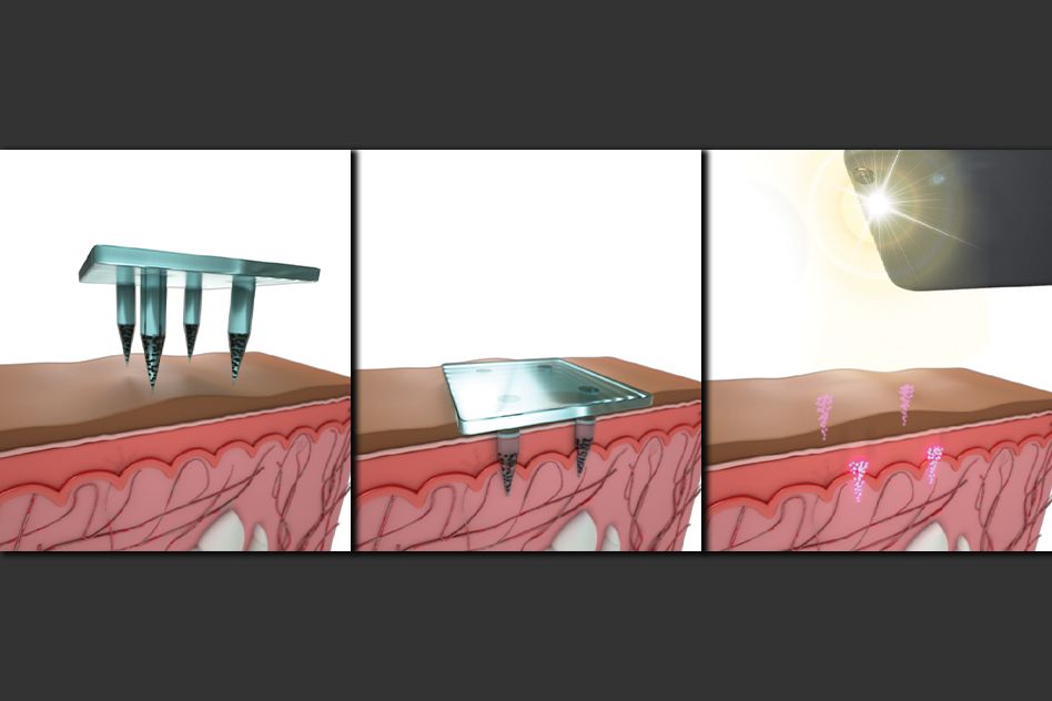 Storing medical information below the skin’s surface