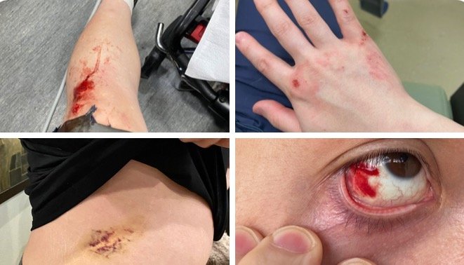 “Antifa Wants Me Dead” – Antifa Terrorists Brutally Beat Journalist Andy Ngo While He Was Reporting on Portland Riots Over the Weekend
