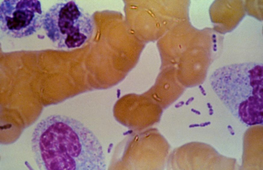 The Plague Kills 10-Year-Old Child In Colorado