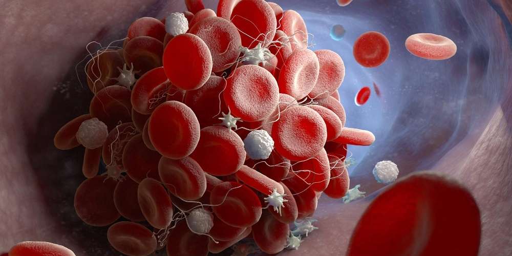 Micro Blood Clots: How Both Covid AND mRNA “Vaccines” Harm and Kill People