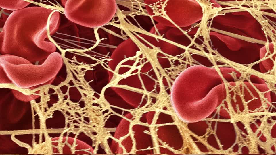 Embalmer reports finding long, fibrous blood clots in deceased people who got COVID-19 vaccine