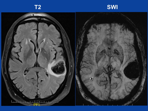 Second COVID-19 Vaccine Dose For 52 Year Old Man Linked To Aphasia According To 2021 Medical Journal Report
