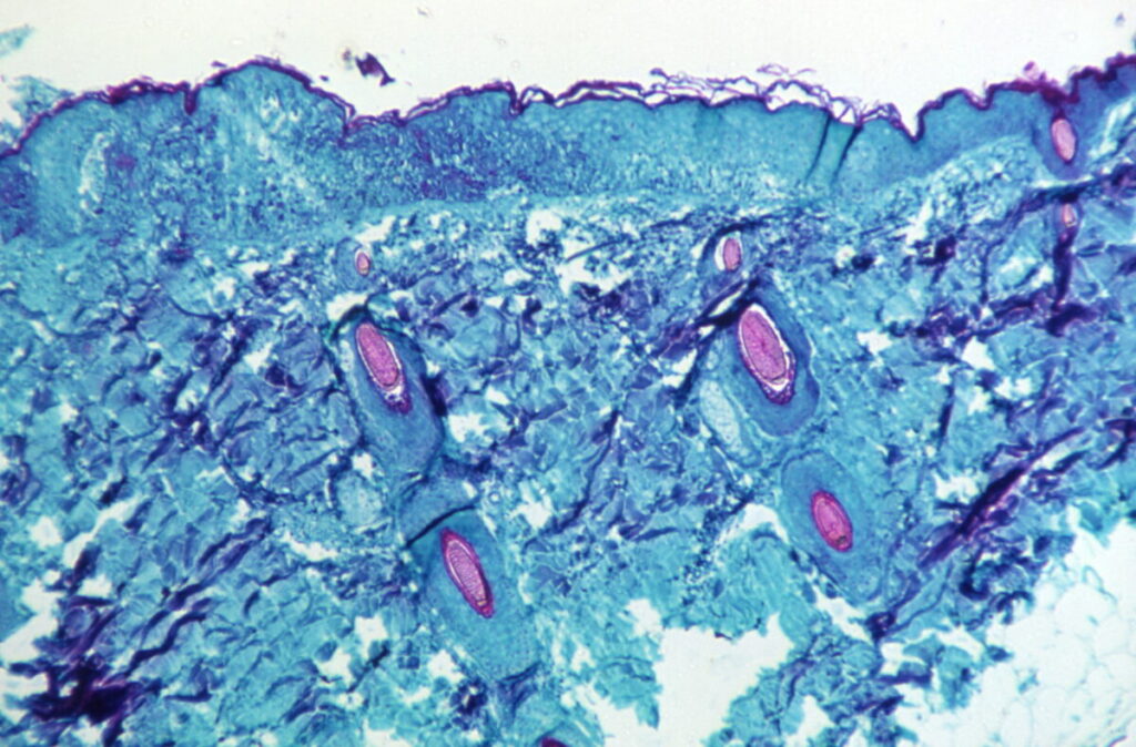 CDC Confirms More Monkeypox Cases Across US