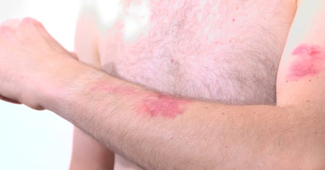 Belgium Imposes Quarantine for Four Detected Cases of Monkeypox