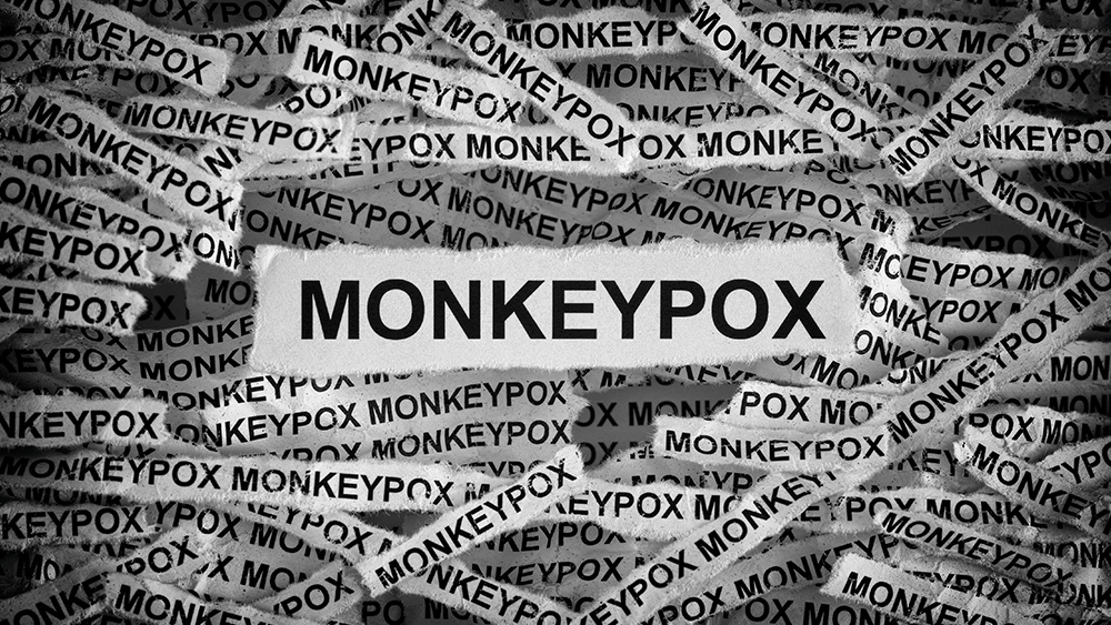 It’s looking more and more like monkeypox is a cover story for covid vaccine-induced shingles, autoimmune blisters and herpes