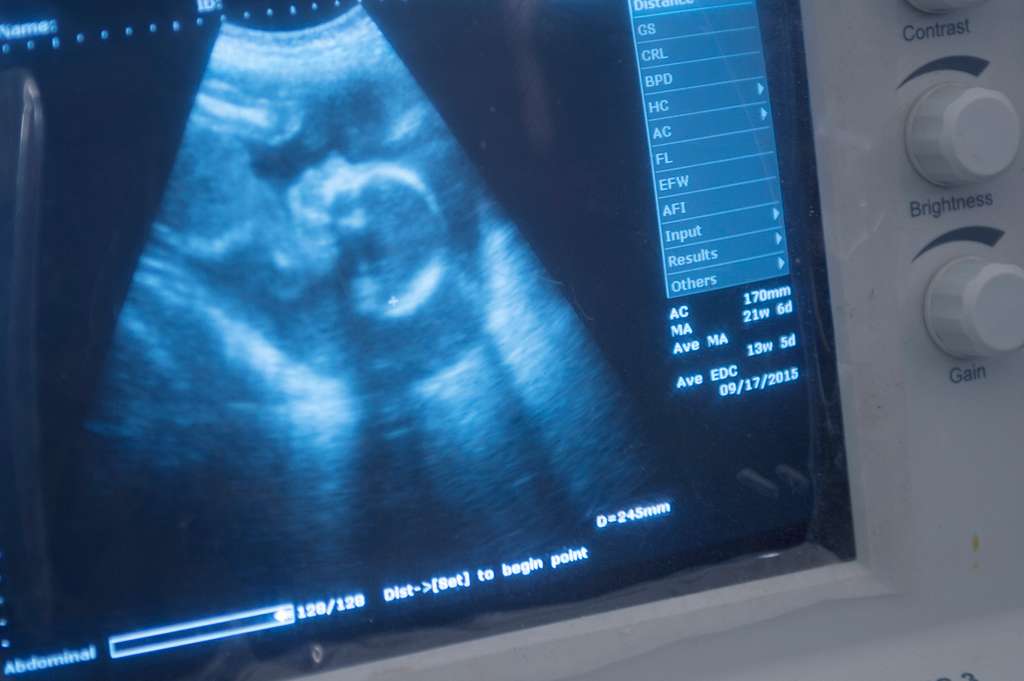Leaked Hospital Email Exposes Stillbirth Explosion Following COVID-19 Jab Rollout