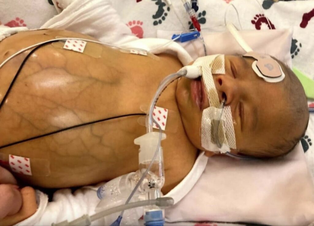 US Mother’s Tragedy: “So My Newborn Alex Died days after Receiving Unauthorized Vaxxed Blood in a Transfusion”