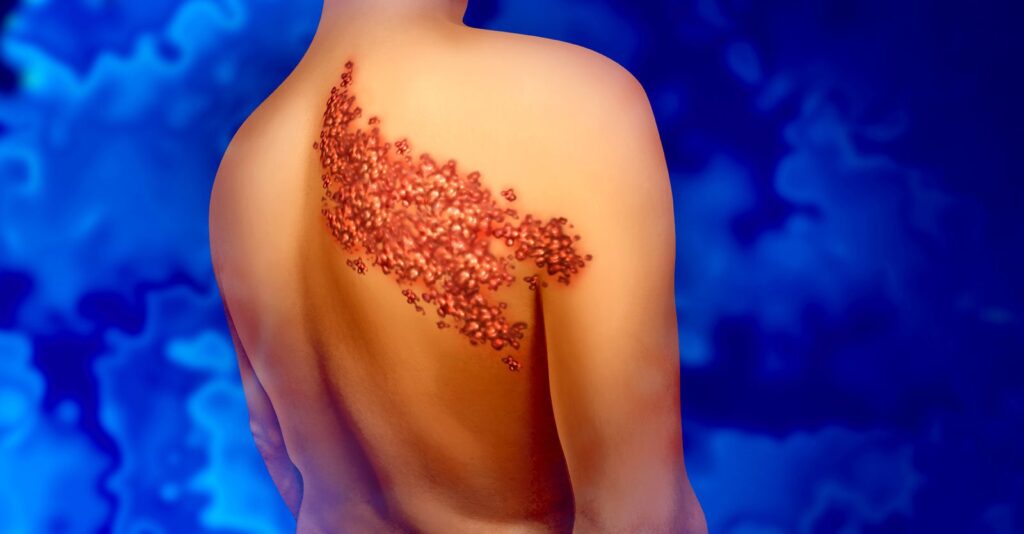 COVID Vaccines Linked to Shingles Reactivation
