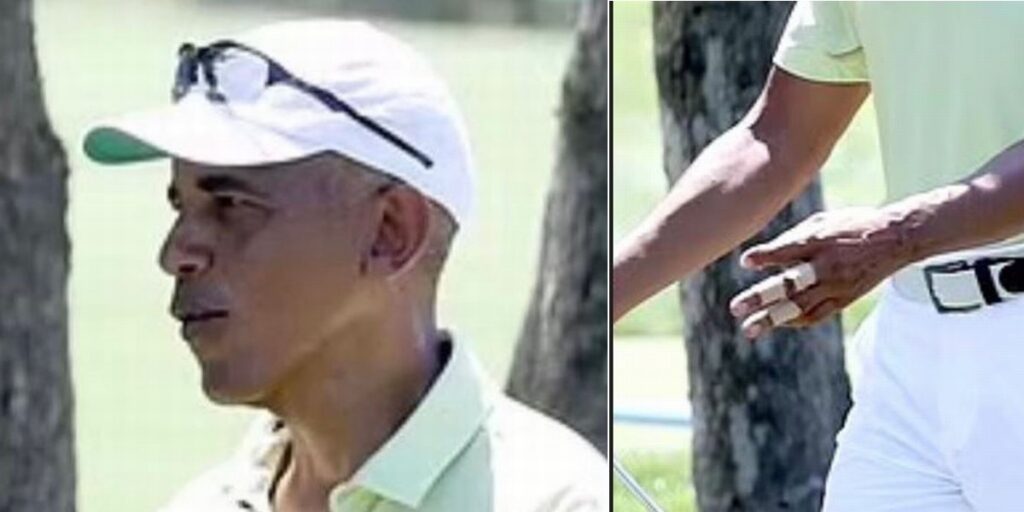 Barack Obama Emerges With Black Eye, Bandaged Hand After Death of Personal Chef