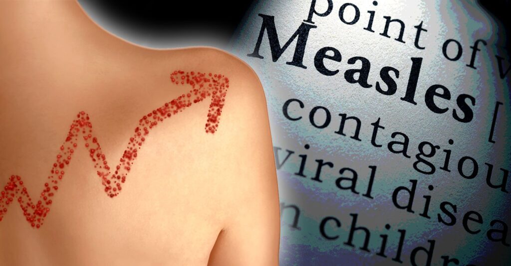 Measles Cases Rise Dramatically — But Not in U.S.