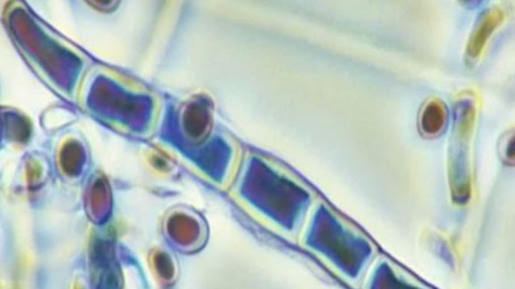 New Sexual Infection Emerges In New York