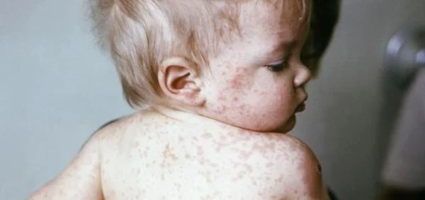 What to do if measles is in your area